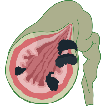 Gastrointestinal Infographic | ELG Law