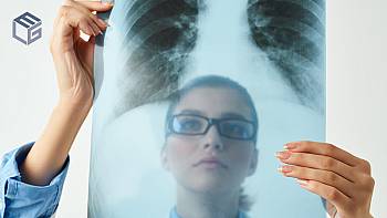 Atelectasis, lung cancer and asbestos exposure