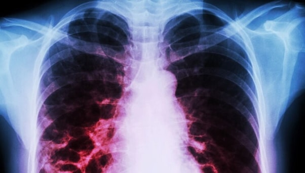 pneumothorax vs atelectasis