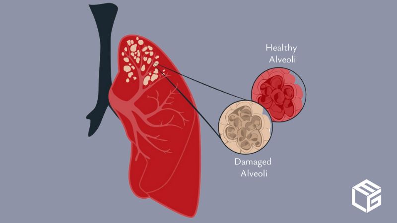 Emphysema  video