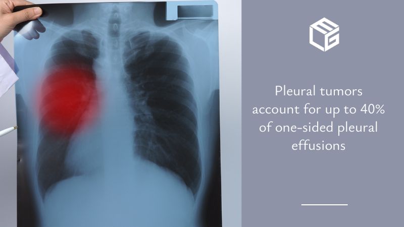 Pleural effusion  video